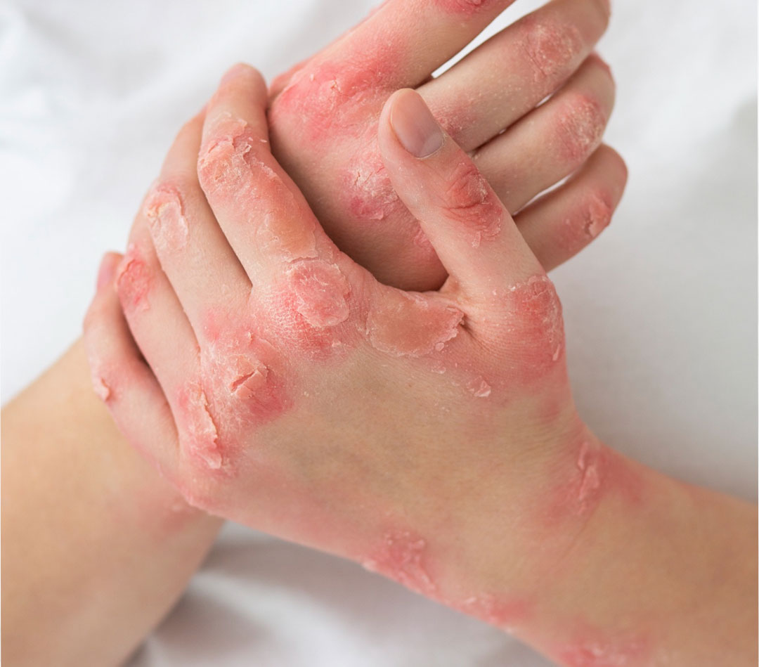 Skin Health Illustration showing healthy and affected skin